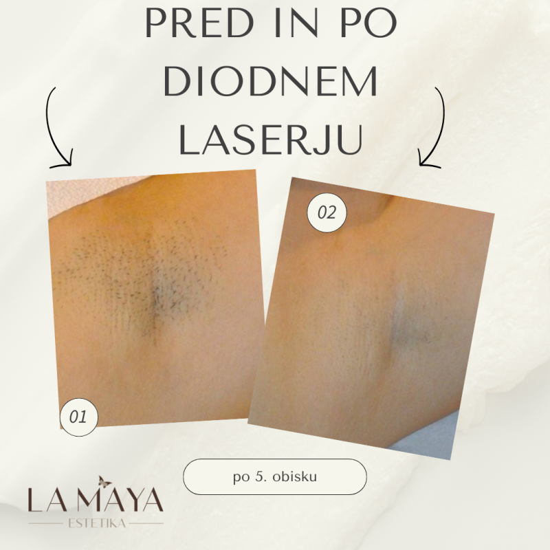 Prej in potem po diodnem laserju 